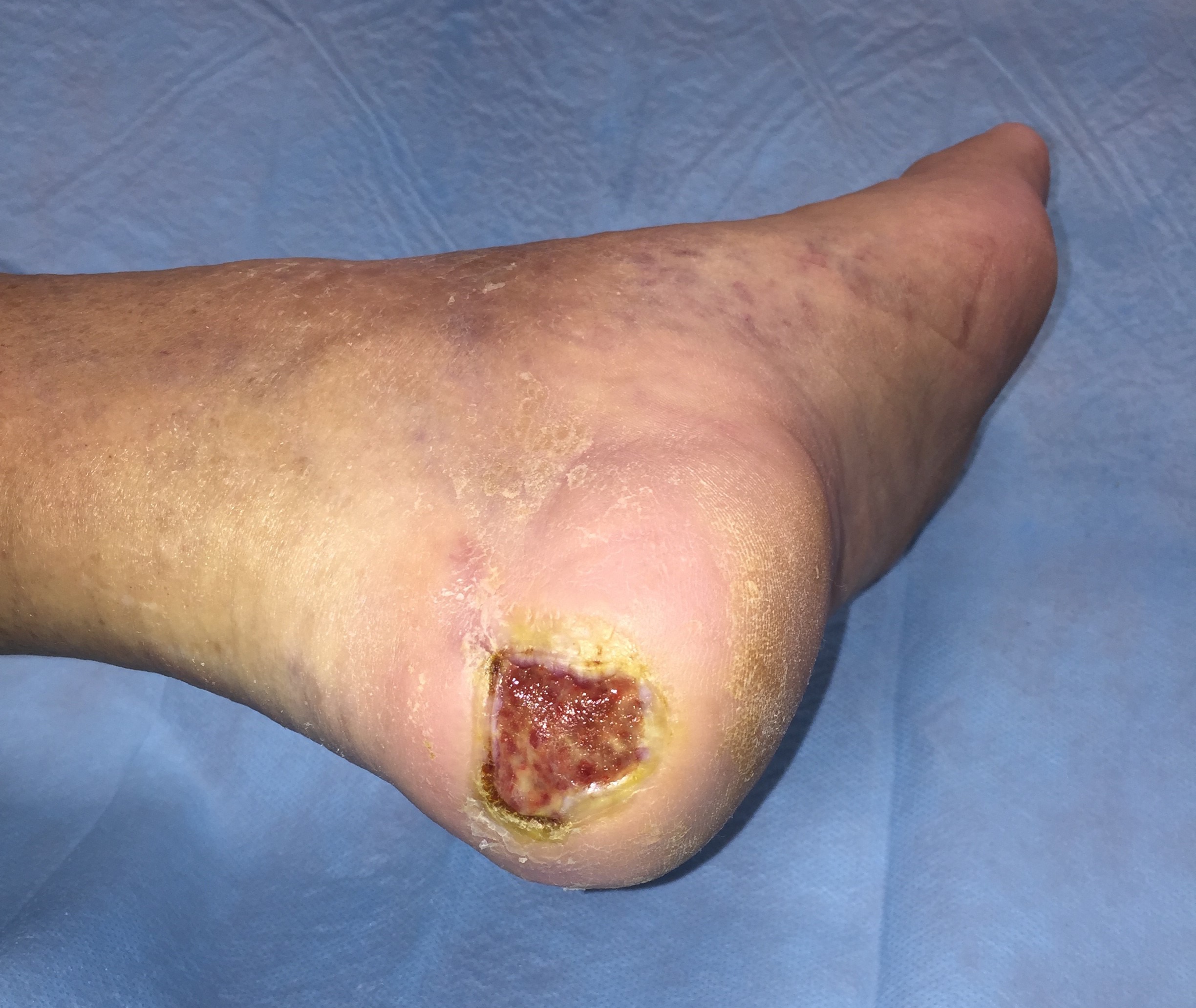 Tratamiento de úlcera de pie diabético levemente infectada en el talón